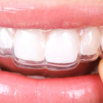 Ealing Dental Specialists - Essix Retainers