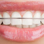 Ealing Dental Specialists - Hawley Retainers