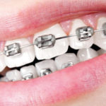 Ealing Dental Specialists - Metal Fixed Braces