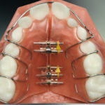 Ealing Dental Specialists - Removable Appliances